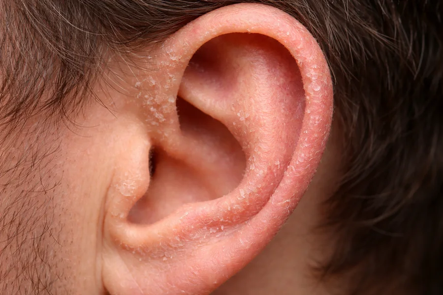 Dry and flaky ear skin
